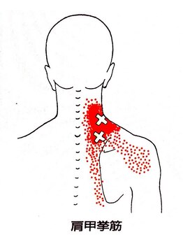 カイロライン国分寺整体院/【肩こり】トリガーポイント例