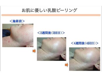 ベッラドンナ(Bella donna)/肌荒れ BeforeAfter