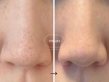 スワン 大阪南堀江(swan)/小鼻の黒ずみ毛穴がお悩みの方
