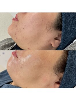 ラ クレール ビューティーサロン(LA CLAIR)/レチノールピール×4回