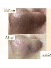 キレイノココロミ(きれいのCoCoRomi)/毛穴エクストラクションtete式