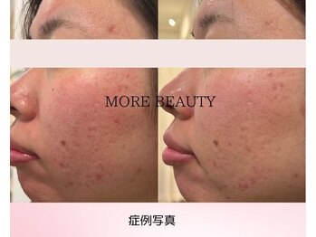 モアビューティー 庚午店(MORE BEAUTY)/症例写真