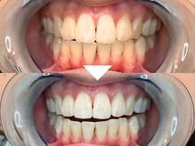 ビースト 下北沢店(B-st.)/セルフホワイトニング｜30分照射