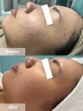 アップユー(UPU)/ハーブピーリング　