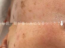 サロンドシエル カスガイ(Salon de Ciel kasugai)/鏡を見るのが好きになるシミケア