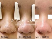 モア(MORE)の雰囲気（リピート率90%超え/毛穴改善エステ60分/10,000円 宇都宮・鶴田）