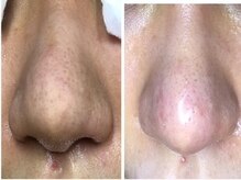 ミントの雰囲気（毛穴エクストラクションの技術で一つ一つ丁寧に洗浄、肌艶◎）