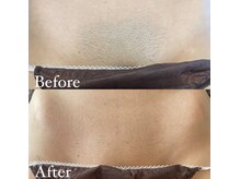 シェン(SHEN)の雰囲気（VIO脱毛Before After１回目でも効果がでます）