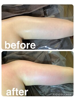 ギンザアール(GINZA R.)/スッキリ二の腕に！