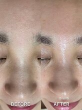サロンドジェシカ(salon de Jessica)/プラズマ＋毛穴洗浄
