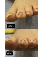 ドクターネイル爪革命 所沢西店/巻き爪［所沢／狭山ヶ丘］