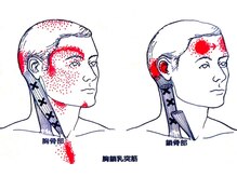 カイロライン国分寺整体院/【頭痛】トリガーポイント例