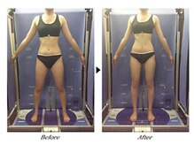 ビューティークリニックコダマ 日南店/【1か月コース】M.S様（25歳）