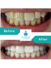 ティンクルホワイト 上尾店/ホワイトニングBefore After