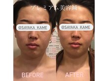 ぶんのいち整体院/美容鍼とデコルテ・首肩ケア付き