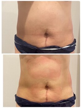 フラットベリー 恵比寿(Flat BELLY)/脂肪冷却2カップ