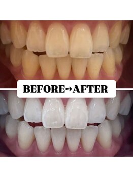 ホワイトニングサロン 豊中/Before&After美白ホワイトニング