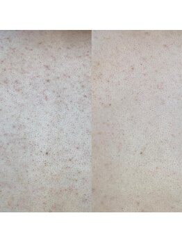 リベル 名古屋(Lebelle:)/ハーブピーリング 名古屋