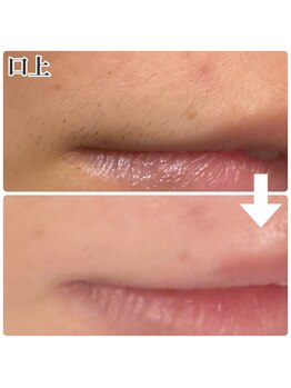 リミー 東大宮店(REME)/ワックス脱毛