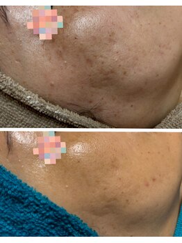 トータルビューティー ココ(Total Beauty CoCo)/【シミケア肌質改善】50代・12回