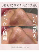 レア(Lea)/いちご鼻もしっかり綺麗に※