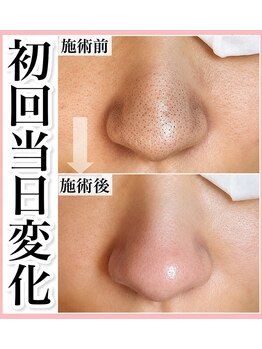 イトウサロン(ITO SALON)の写真/《毛穴汚れ・皮脂スッキリ！》水流の力で蓄積汚れをオフ◎キメを整え、思わず触れたくなるなめらか素肌へ