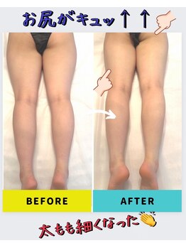 パルファンドゥー(parfum doux)/痩身【下半身】ビフォーアフター