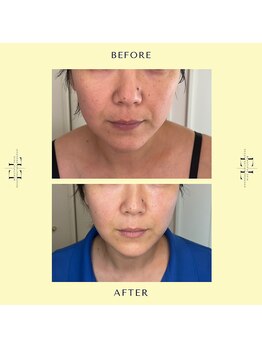 シェリエ(CHERIE)/エクソリフト