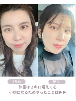 リジュベネ(rejuvena)/【小顔になるためやったこと】