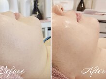 プラズマフェイシャル/EMS/カッサでリフトアップ★京都烏丸御池