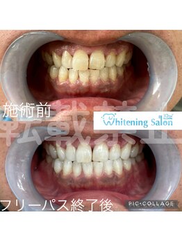 ホワイトニングサロン 名古屋 栄店/【ホワイトニング】