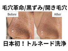 リノア(Lino'aka)/毛穴洗浄3回コース