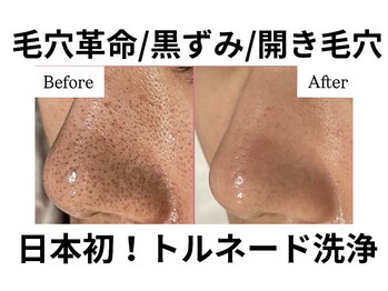 リノア(Lino'aka)/毛穴洗浄3回コース