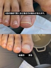 巻き爪じゅん 千葉駅前店/改善しなかった足の痛みに変化が