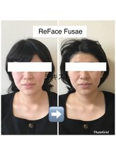 リフェイスフサエ(ReFace Fusae)/ビフォー& アフター