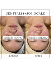 サロン ド ブラン アオヤマ(Salon de BLANC AOYAMA)/SENTEALES×Sonocare