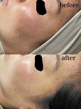 ニコリ(Nicori)/シェービング＋光フェイシャル