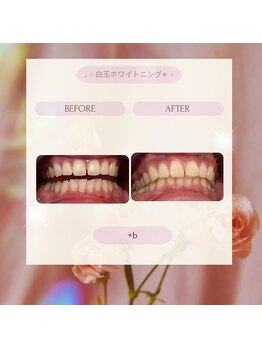 プラスビー 2号店(+b)/ホワイトニングビフォーアフター