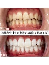 ホワイト 福岡天神店(WHITE)/ホワイトニングビフォーアフター