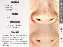 ルディラ 上野店/ハイドラフェイシャル