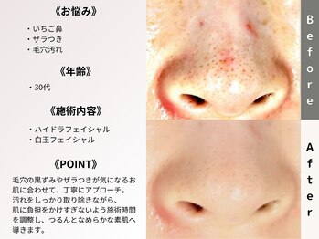 ルディラ 上野店/ハイドラフェイシャル