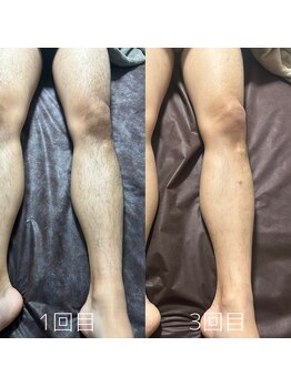 カナウ(KANAU)/足脱毛（20代前半男性）