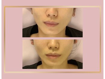 小顔美肌コルギ専門店 センティード 吉祥寺(Sentido)/『小顔美肌コルギ』5回目