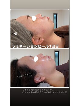陽月 鍼灸院整骨院/美容鍼+ラミネーションピール