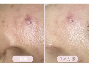 エピル(EPIL)/スキンケアセット症例