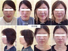 ライフサロン 天神(Life Salon)の雰囲気（小顔/フェイスライン/ほうれい線/Before・After）