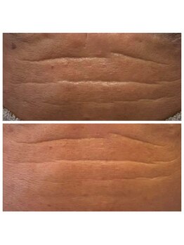 ディープブルー(Deep Blue)/プラペンデュアル施術