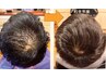 【男性必見◎】育毛促進スパ10分+頭浸浴+ ヒト幹細胞導入+照射20分¥16500