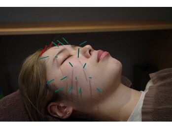 栄光治院 安城院の写真/鍼施術で自律神経を整え、不眠・ストレス・肩こり・めまい・耳鳴りに◎栄光治院で心身リフレッシュ♪