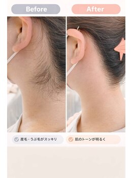 キアラ 麻布十番(Kiara)/うなじワックス/麻布十番/毛穴